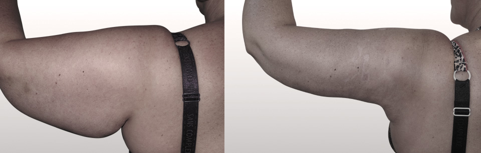 lifting face interne du bras