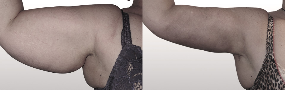 lifting face interne du bras
