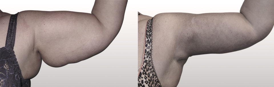 lifting face interne du bras