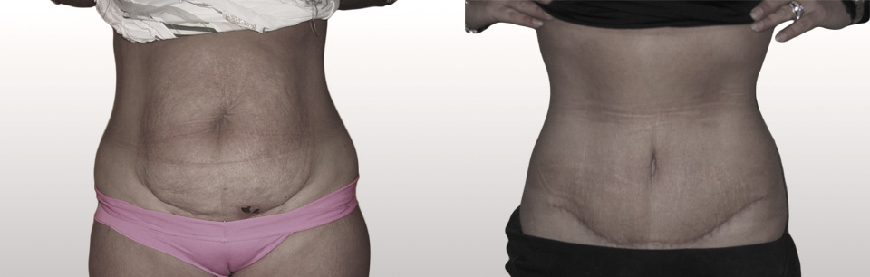 11.Plastie abdominale