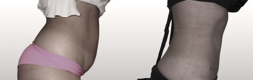 12.Plastie abdominale