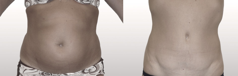 13.Plastie abdominale