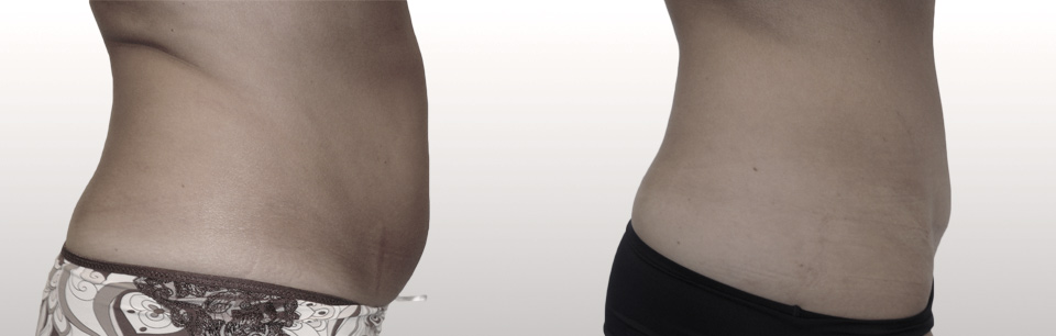 14.Plastie abdominale
