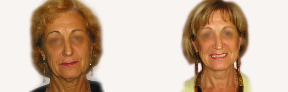 lcf